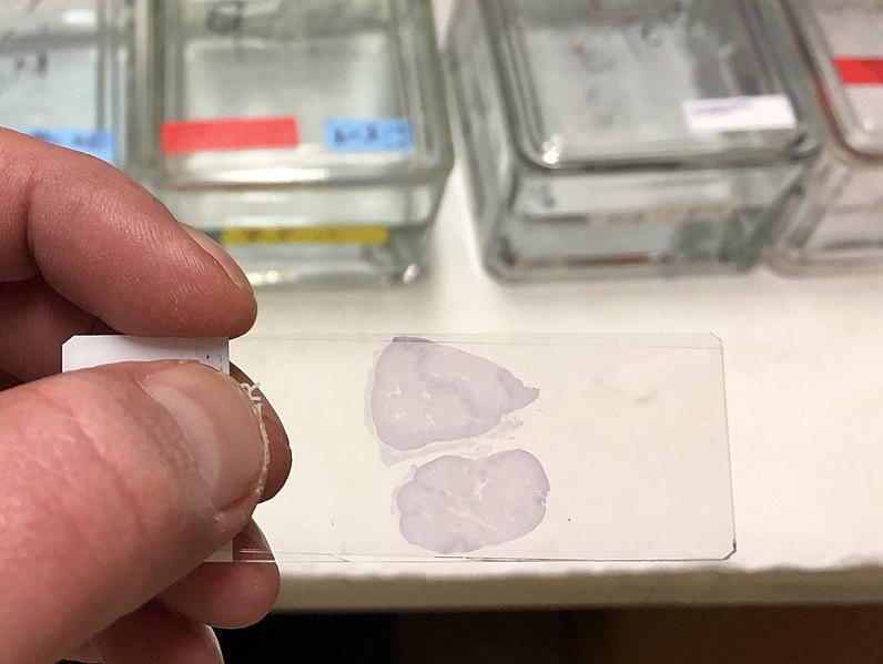 Photograph of a microscope slide being held up in a person's hand. The slide has a purple coloured sample of biological tissue on it.